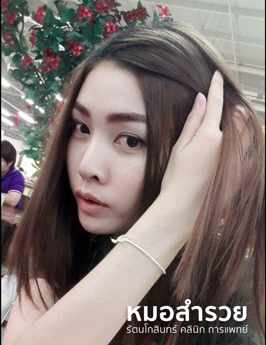 เสริมจมูก 2 ปี