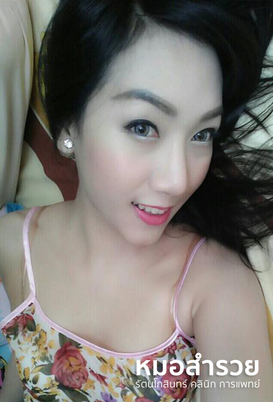 เสริมจมูก 3 ปี