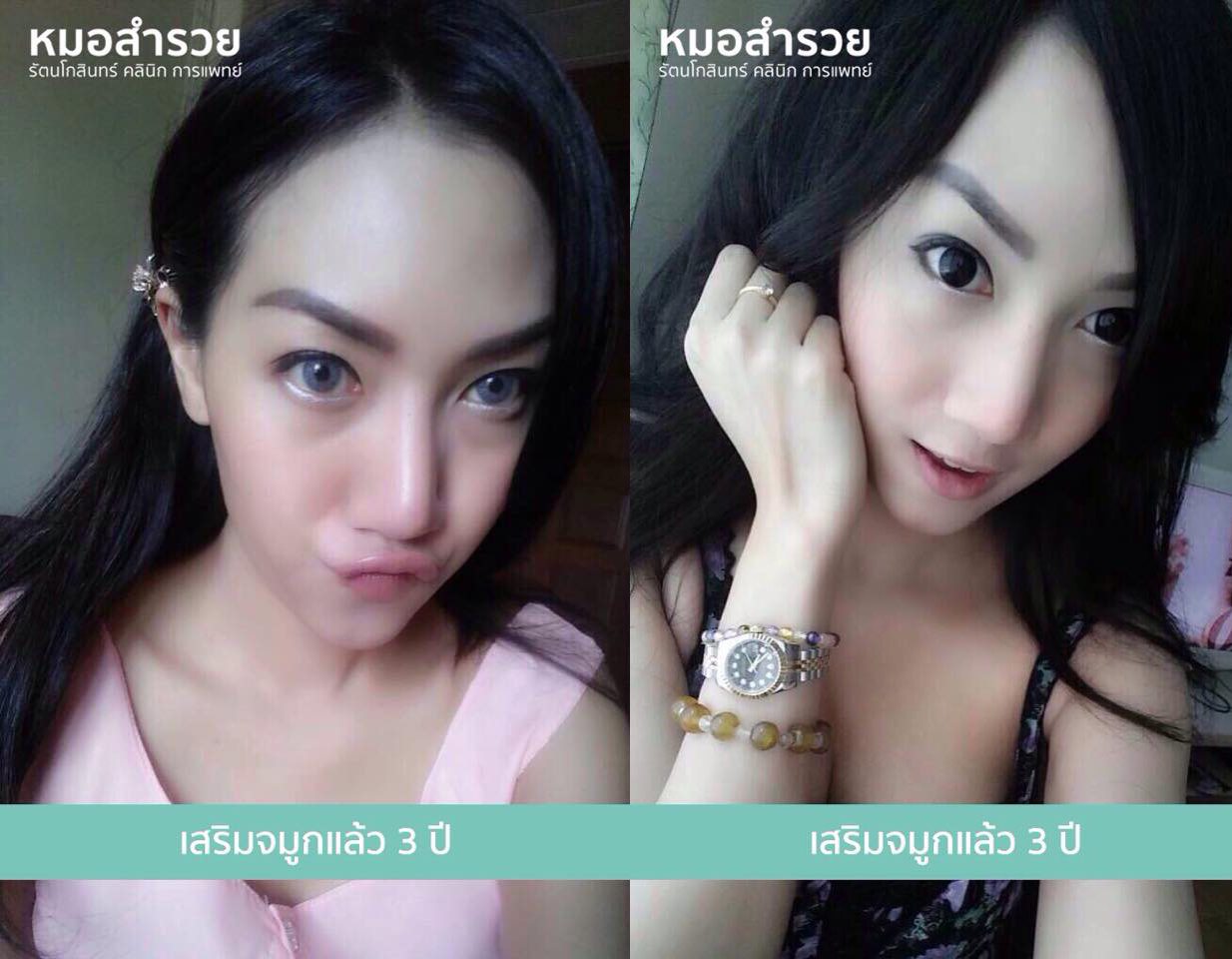 เสริมจมูก 3 ปี