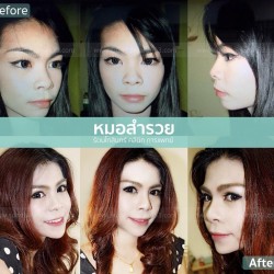 เสริมจมูก 8 ปี