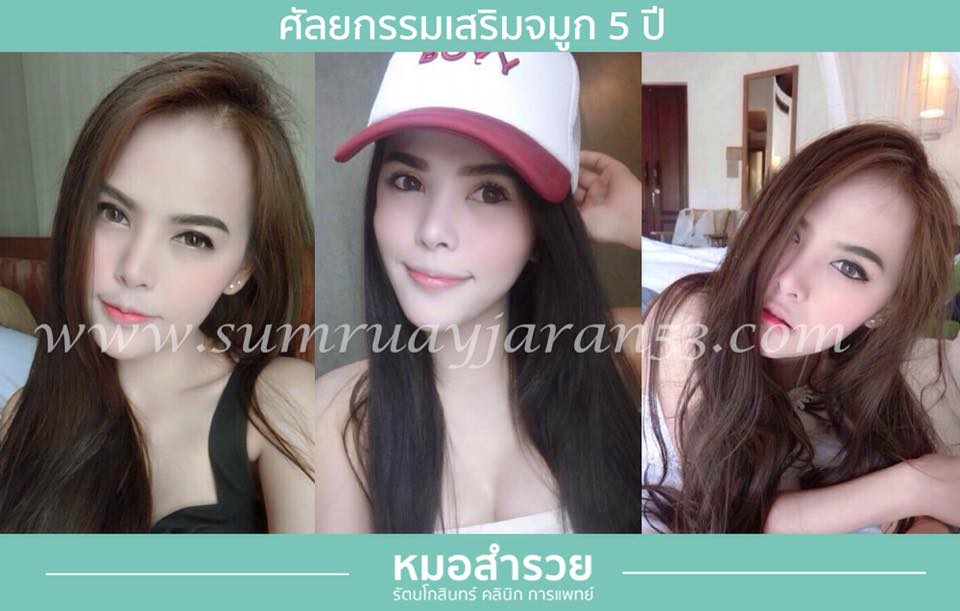เสริมจมูก 5 ปี