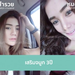 เสริมจมูก 3 ปี