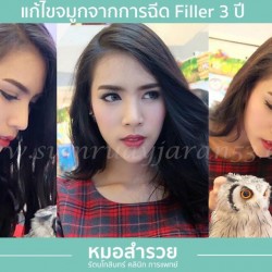 แก้ไขจากการฉีด Filleที่อื่น 3 ปี