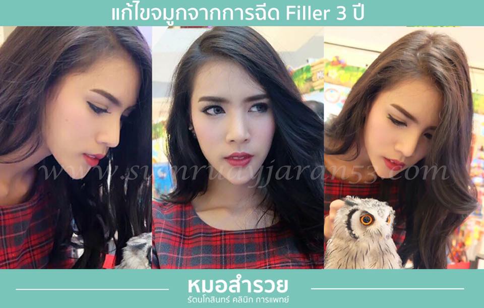 แก้ไขจากการฉีด Filleที่อื่น 3 ปี
