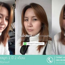 เสริมจมูก 1ปี 2 เดือน
