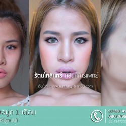 เสริมจมูก 1 เดือน