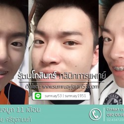 เสริมจมูก 11 เดือน