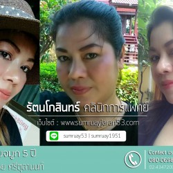 เสริมจมูก 5 ปี