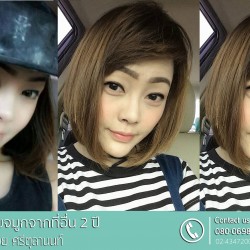 แก้ไขจมูกจากที่อื่น 2 ปี