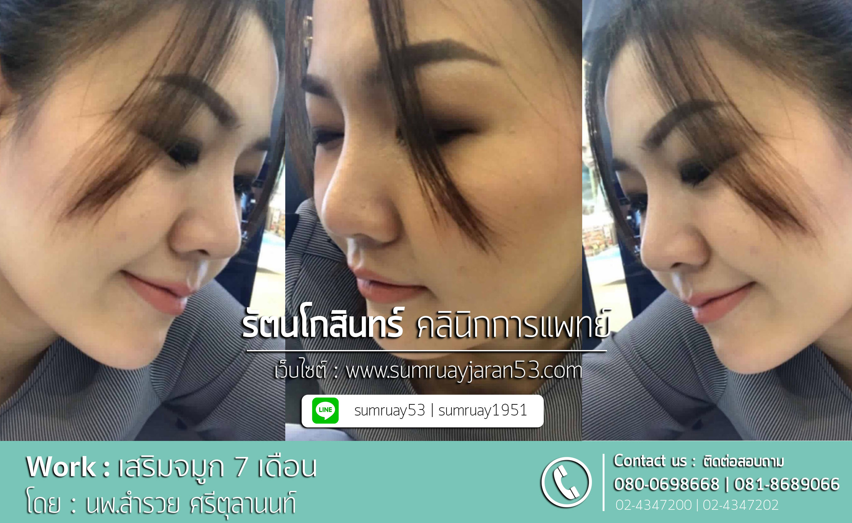 เสริมจมูก 7 เดือน