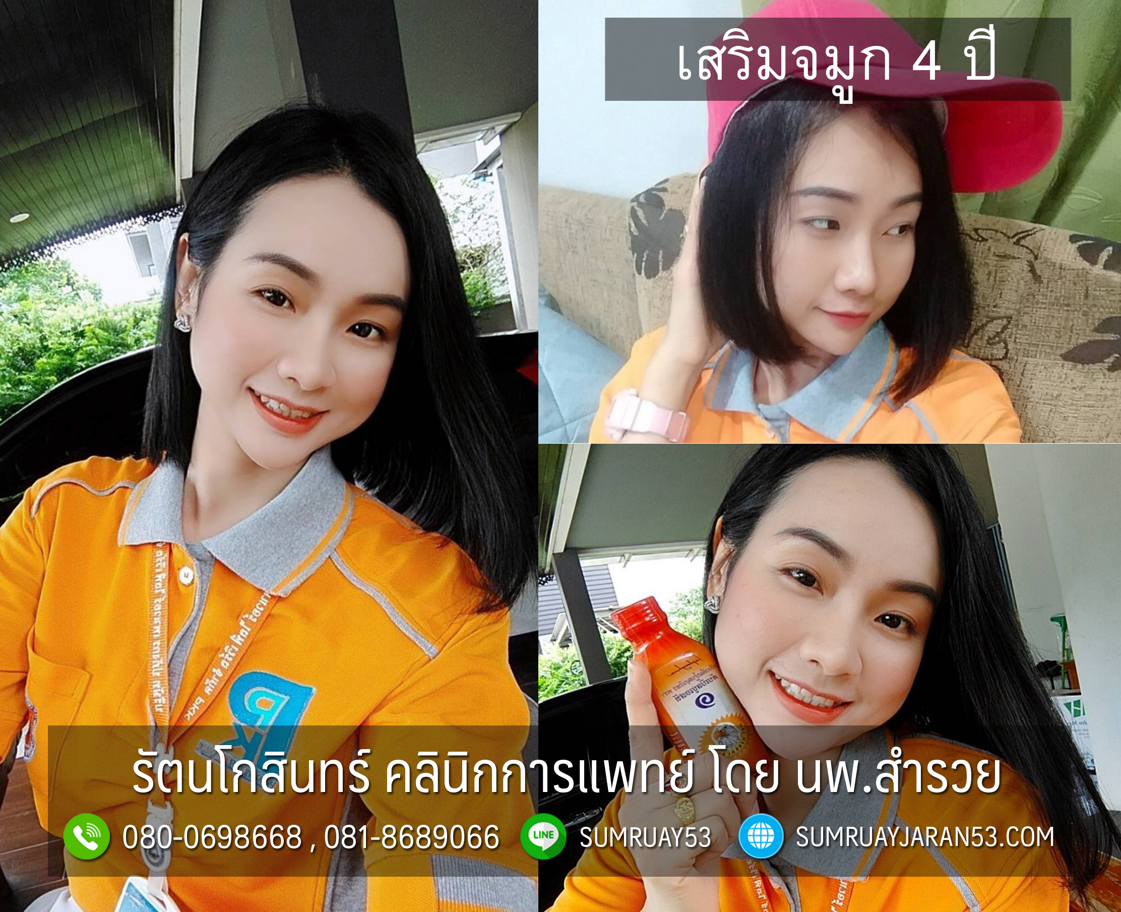 เสริมจมูกกับหมอสำรวย 4 ปี